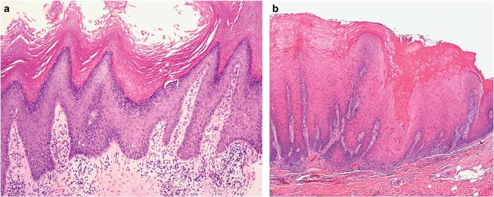 (a) Biopsy showed hyperorthokeratosis, a prominent granular cell layer, a verrucoid epithelial architecture associated with interface mucositis.