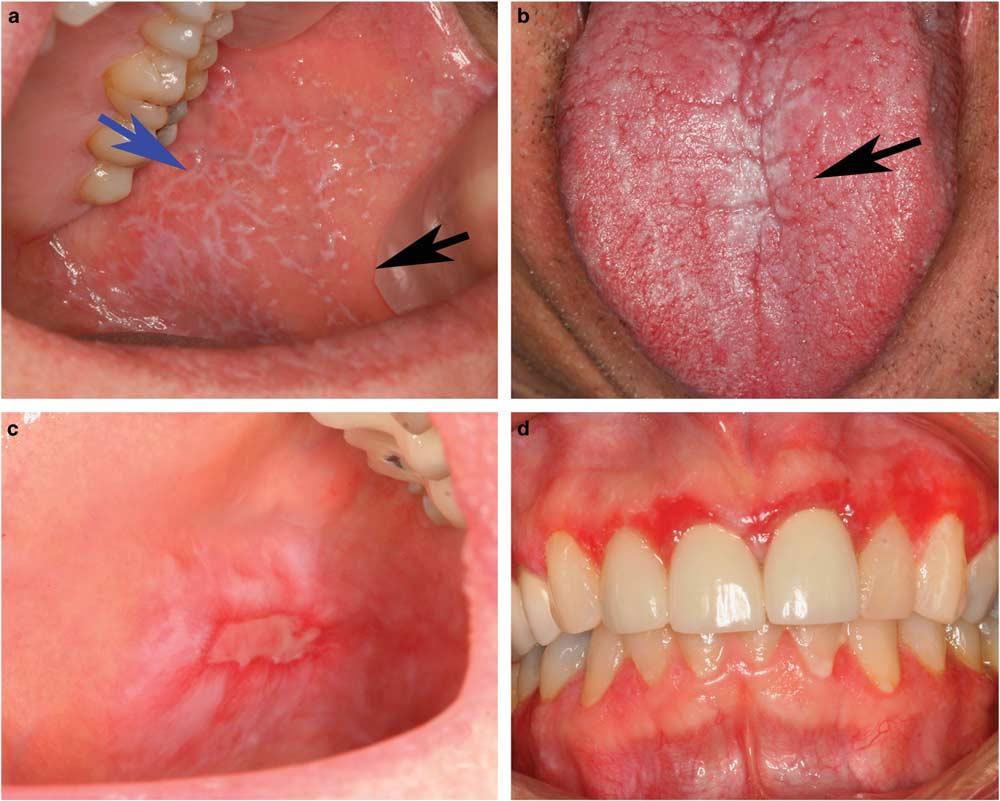Oral lichenoid lesions S55 Figure 1 Clinical patterns of oral lichen planus.