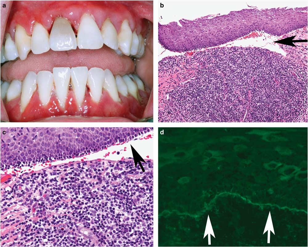 Oral lichenoid lesions S59 Figure 5 Mucous membrane pemphigoid presenting as desquamative gingivitis similar to the atrophic form of oral lichen planus.