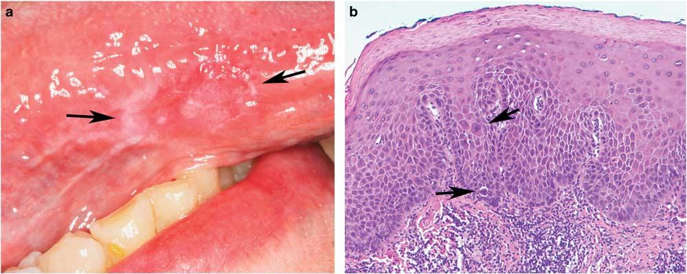 S62 Oral lichenoid lesions Appropriate clinical history is necessary in formulating a diagnosis as oral lichen planus and chronic graft versus host disease have overlapping histology.