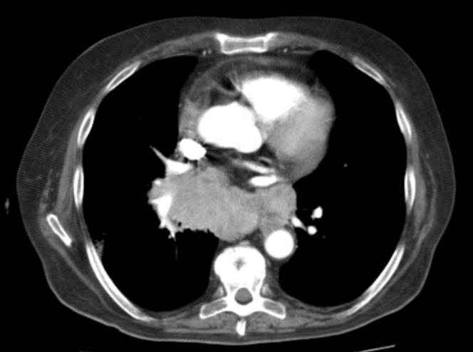Fig. 9: Axial contrast-ct scan shows a lung parenchymal mass obstructing the intermediate