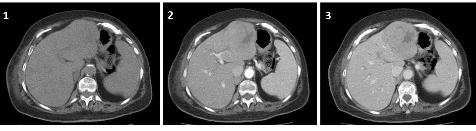 Fig. 1: Axial CT (1: non-enhanced, 2: arterial phase contrastenhanced, 3: portal phase contrast-enhanced)