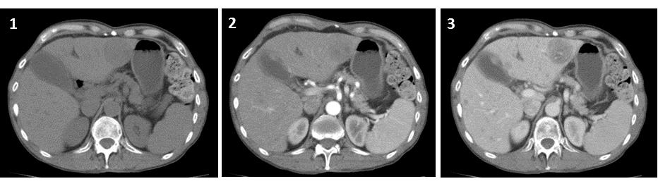 lesions in the right lobe of the liver without significant contrast enhancement in a  3: Axial CT (1: