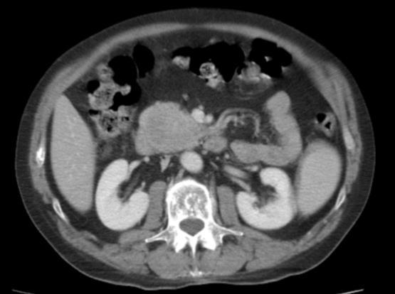 Fig. 4: Axial contrast-ct scan shows a hypodense head pancreatic mass with mild