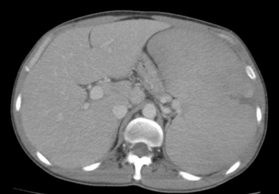 5: Contrast-CT scan showed a homogeneous splenomegaly in patient with myeloma.