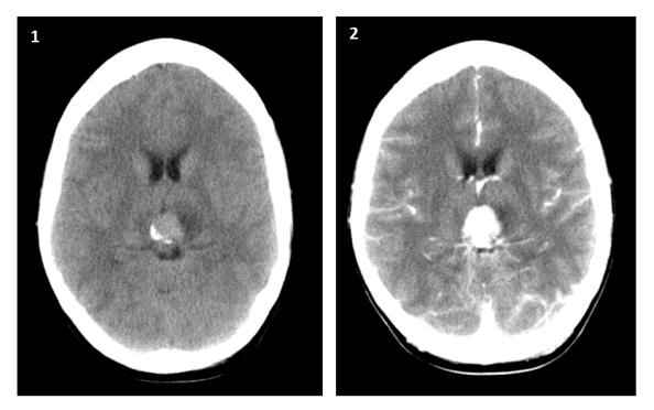 6: 1: Axial non-enhanced CT scan. 2: Axial contrast-ct scan.