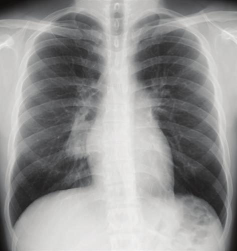 2 Case Reports in Surgery Figure 1: Chest radiograph shows a mass lesion located in the right infrahilar region.
