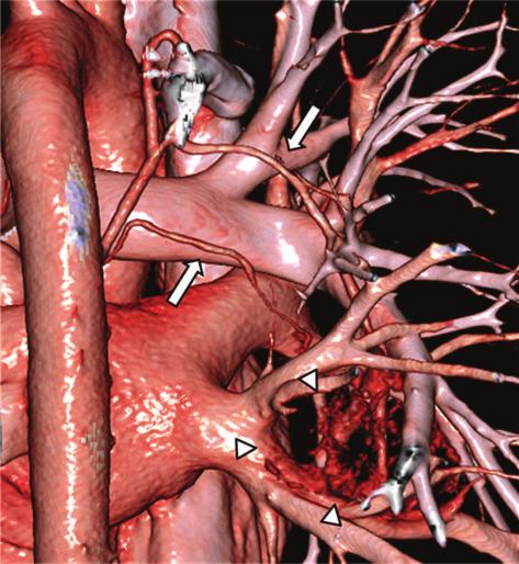 4 Case Reports in Surgery References Figure 3: 3D-CT angiography demonstrated the enlarged feeding vessels at the surface of the mass (arrowheads) originating from 2 bronchial arteries (arrows).