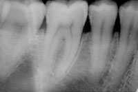 The radiograph reveals a radiolucency on the distal surface of tooth No. 29. Figure 5.