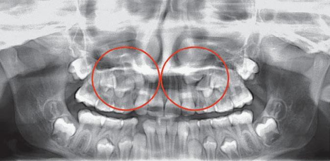 PREVENTION OF TOOTH IMPACTION WITH INVISALIGN: A CASE REPORT Fig 5 July 2014. A panoramic radiograph shows the thickness of the dental follicle around tooth 23. Fig 6 July 2014.