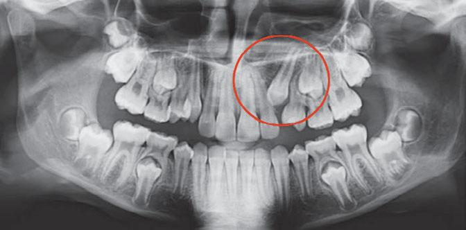 eruption of permanent teeth thanks to the deciduous teeth extraction. and 21 had started to come out from the dental arch. There was a risk of there being a lack of room for teeth 12 and 22.