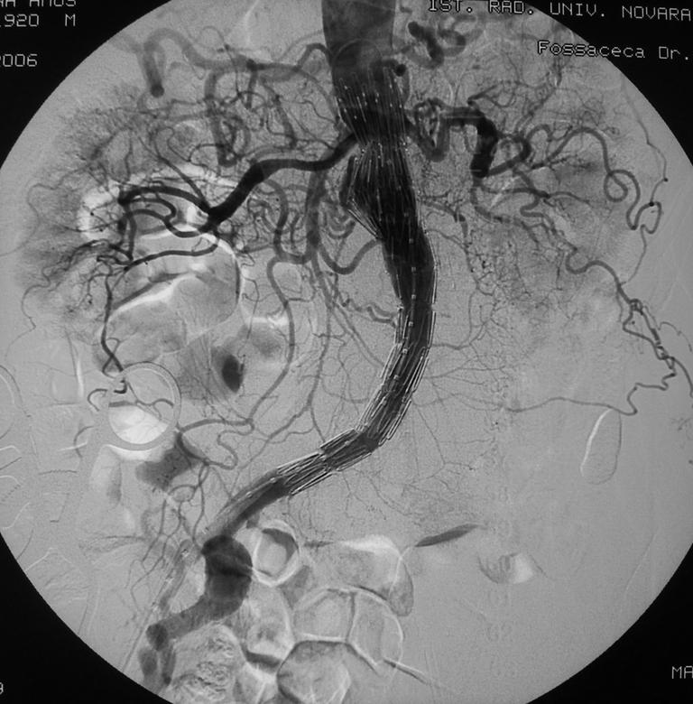 An aorto-uni-iliac