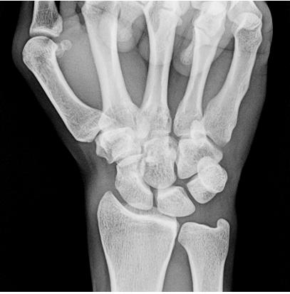 What has happened to my wrist? A fracture is a break or divide in a bone. The wrist is made up of 2 long bones of the forearm, and lots of little bones in the wrist itself.
