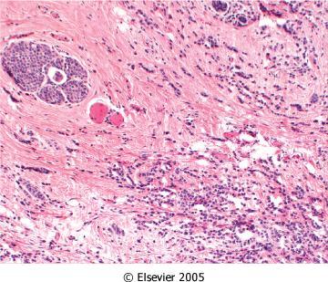 Therefore neoplastic cells will not have metastasised and prognosis is better than invasive carcinoma Lobular carcinoma in-situ (LCIS) refers to CIS found within the terminal duct-lobular unit (the