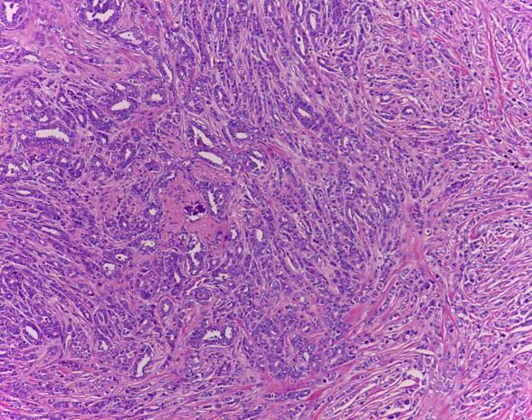 Col HE 40X Fig. 5 Carcinoma in situ, comedocarcinom type. Col HE 200X Fig.