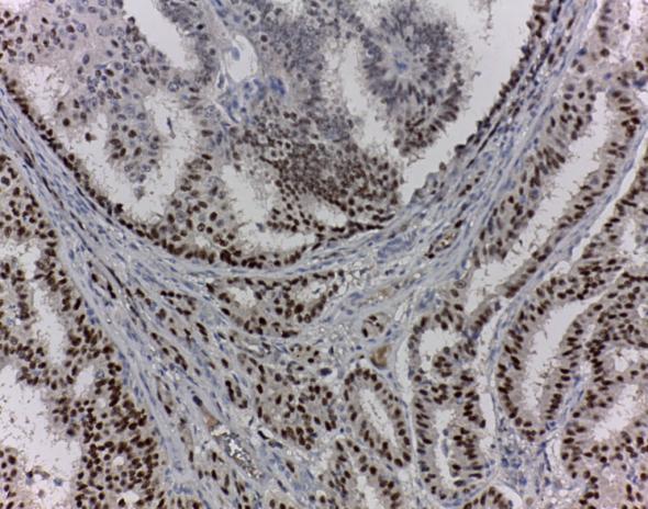 We considered positive score nuclear immunostaining in more than 10% of