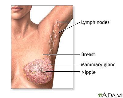 Mastectomy Total (simple) Mastectomy Removal of whole breast.