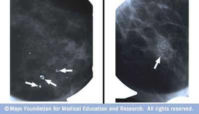 Diagnose with spot compression/magnification if screening mammo shows abnormality (better imaging of particular region) **Mammography misses 10 20% of clinically palpable cancers.