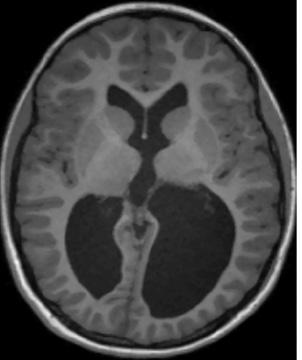 34 ANNUAL REPORT 2016/2017 Clinical imaging (continued) BIOMEDICAL INFORMATICS Figure 1. Structural MRI of patient with cerebral palsy displaying severely enlarged lateral ventricles.