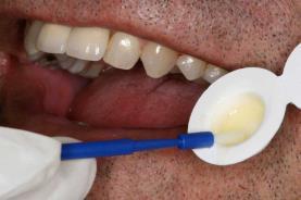 Fluoride varnish is a sticky substance that adheres to teeth, allowing fluoride to be in touch with the tooth for several hours after application.