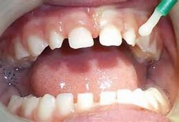 Varnish is a good intervention for infants and toddlers, seniors with root caries, some developmentally disabled individuals, or people with severe gag reflexes who otherwise might not tolerate