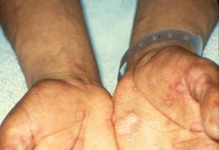 Targetoid Lesions (Erythema Multiforme) Round