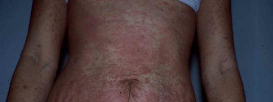 Urticaria Wheals that come and