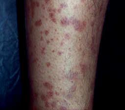 papules/macules Usually