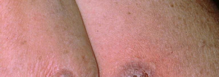 Erythema Nodosum Not an infection Reaction pattern to strep, cocci,