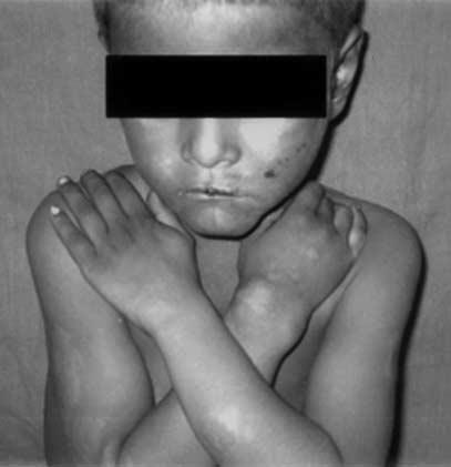 Genital involvement and type I reaction in children 255 Figure 1. Infiltrated plaques of leprosy in type I reaction over face and upper limbs.