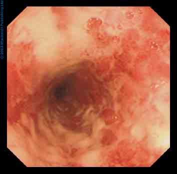 Mild-moderate Ulcerative Colitis Sequential & Combined