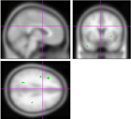 fmri and Voxel-based Morphometry in Detection of Early Stages of Alzheimer s Disease running under MATLAB R2010a (The Mathworks, Sherborn, MA, USA) programming.