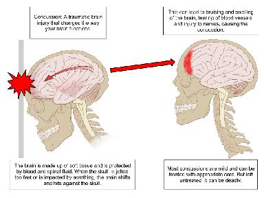 NS Injuries A concussion is when your brain hits the skull bone, bruising the brain.