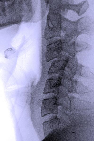 NS Injuries Spinal cord injuries happen when the spinal cord is crushed or cut.