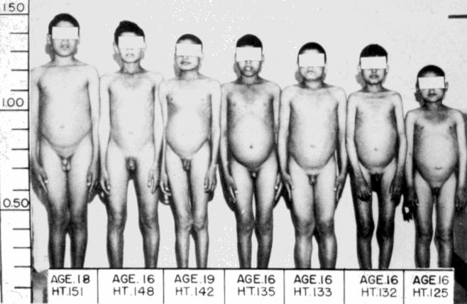Delayed sexual development Zinc deficient Egyptian dwarfs. From Prasad et al.