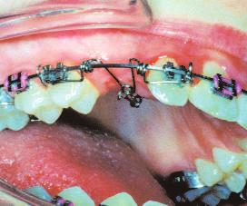 The management of impacted teeth is a common problem in contemporary orthodontics.