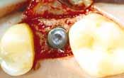 Stable insertion of the implant at the