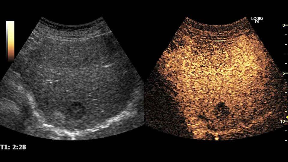 A potential advantage of using SonoVue CEUS would be the option of completing the assessment at the same time as the initial unenhanced ultrasonography.