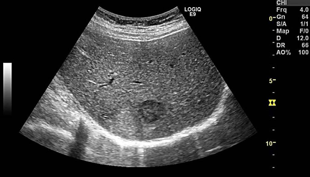 [23] in the following statement: Use CEUS as first method of choice for the diagnostic work up of focal liver lesions if B-mode and Dopplerultrasonography are not conclusive.