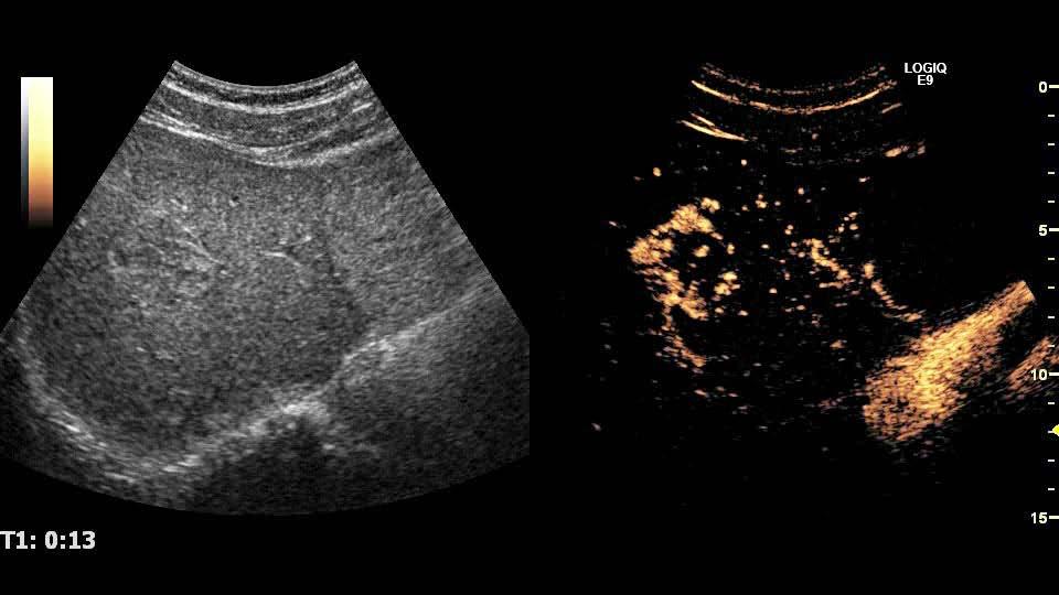 The current guidelines are identical to the 2004 guidelines with regard to this issue, and state that CEUS is indicated for incidental findings on routine ultrasonography.