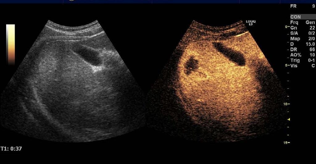 B-mode transverse sonogram shows two hyperechoic lesions (between crosshairs) in both lobes of the liver. B.