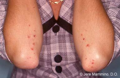 Dermatitis Herpetiformis Flesh-colored to erythematous vesicles appear in a herpetiform pattern Symmetrically distributed over extensor surfaces including elbows, knees, buttocks, shoulders, and the