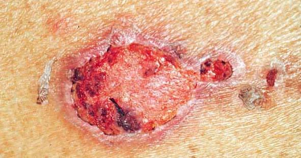 Pemphigus Vulgaris Mucous membranes, usually oral cavity with erosions Flaccid and fragile skin blister filled with clear fluid that