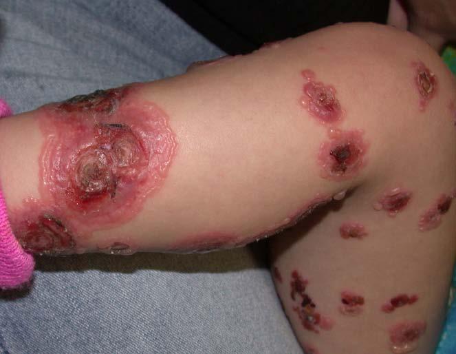 Childhood lesions (Chronic bullous disease of childhood) Localized to the lower abdomen and anogenital areas with frequent