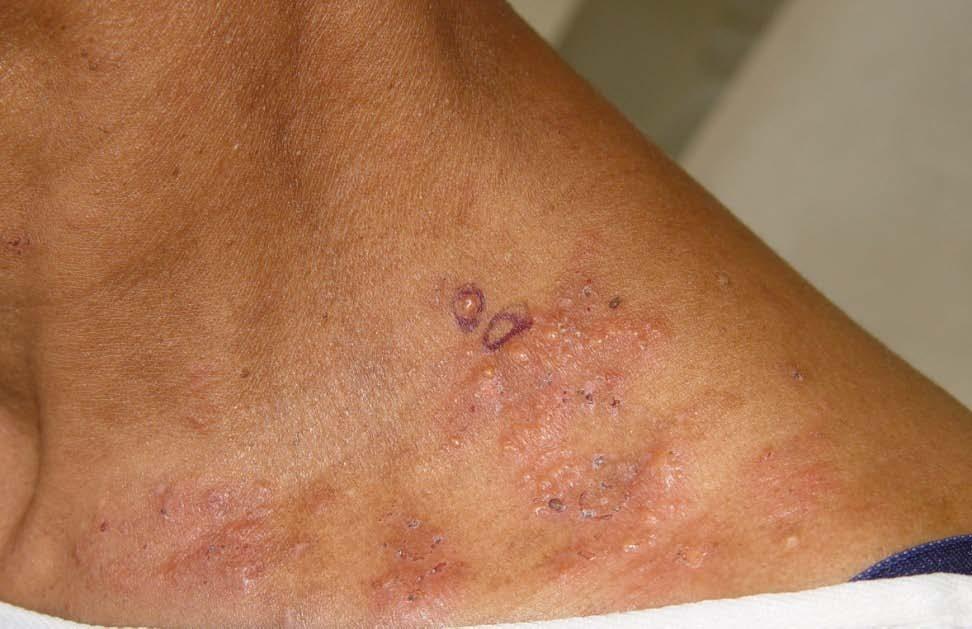 Linear IgA Disease-Adults Trunk and the limbs are most