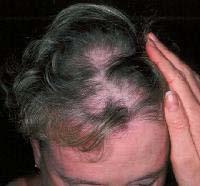 Dermatomyositis Scalp involvement in DM is relatively common (coup d sabre) Calcinosis of the skin or the