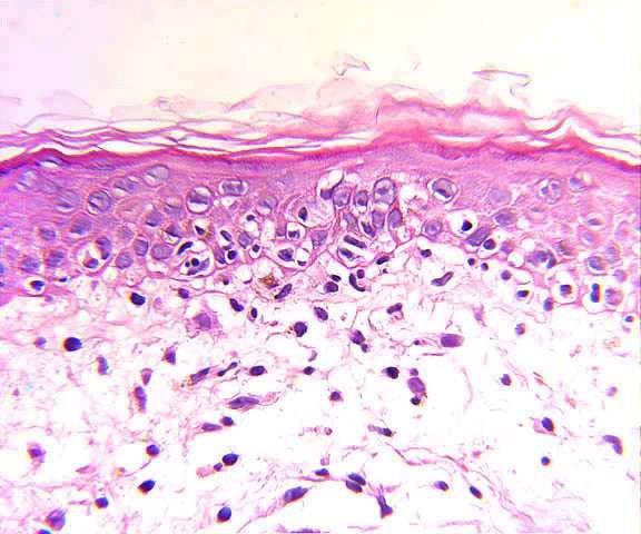 Dermatomyositis Histopathology Cell poor interface dermatitis with dermal