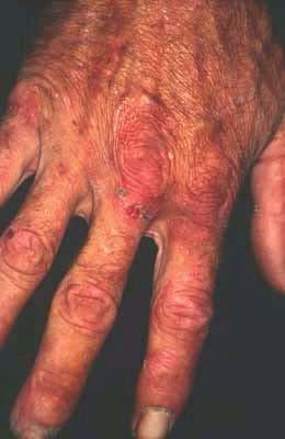Clinical Fragility of sun-exposed skin after trauma Erosions and bullae on the dorsal aspects of the hands, the forearms, and the face Healing of crusted erosions and blisters leaves scars, milia,