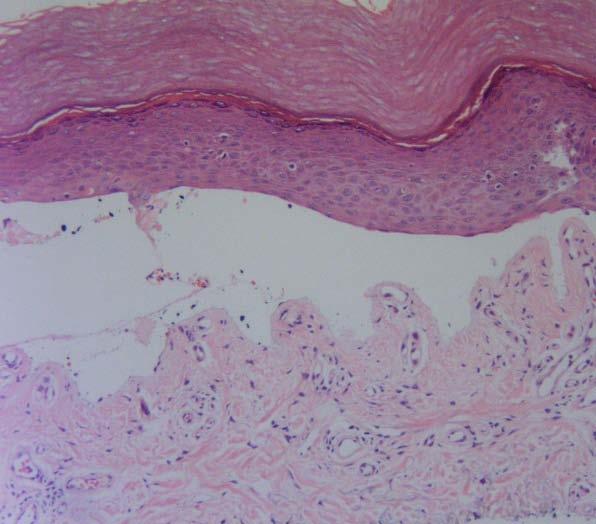 Porphyria Subepidermal bullae with minimal dermal inflammatory infiltrate festooning of dermal papillae