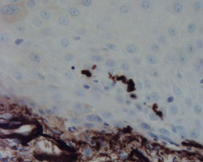 sclerosis Trapped basement membrane zone (caterpillar bodies) in epidermal roof (Ab to Collagen